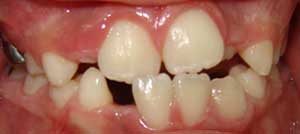 Clasificación de mordida cruzada dental anterior / A - Anterior parcial