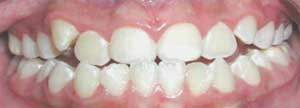 Clasificación de mordida cruzada dental anterior / B - Anterior total