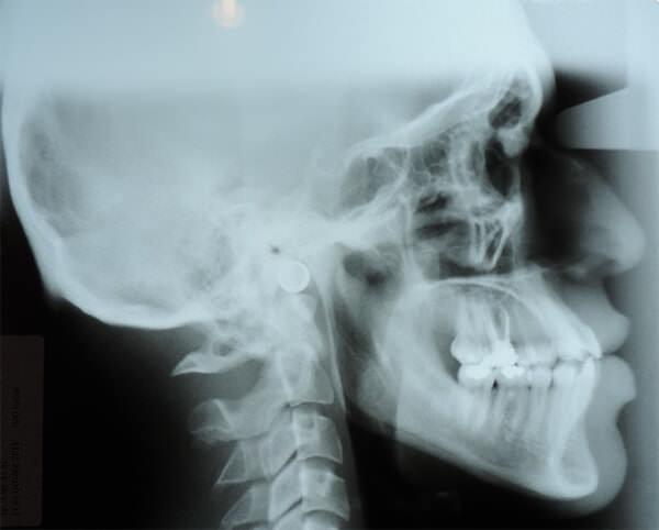 Fig 1. Paciente clase lll con prognatismo mandibular y retrusión maxilar