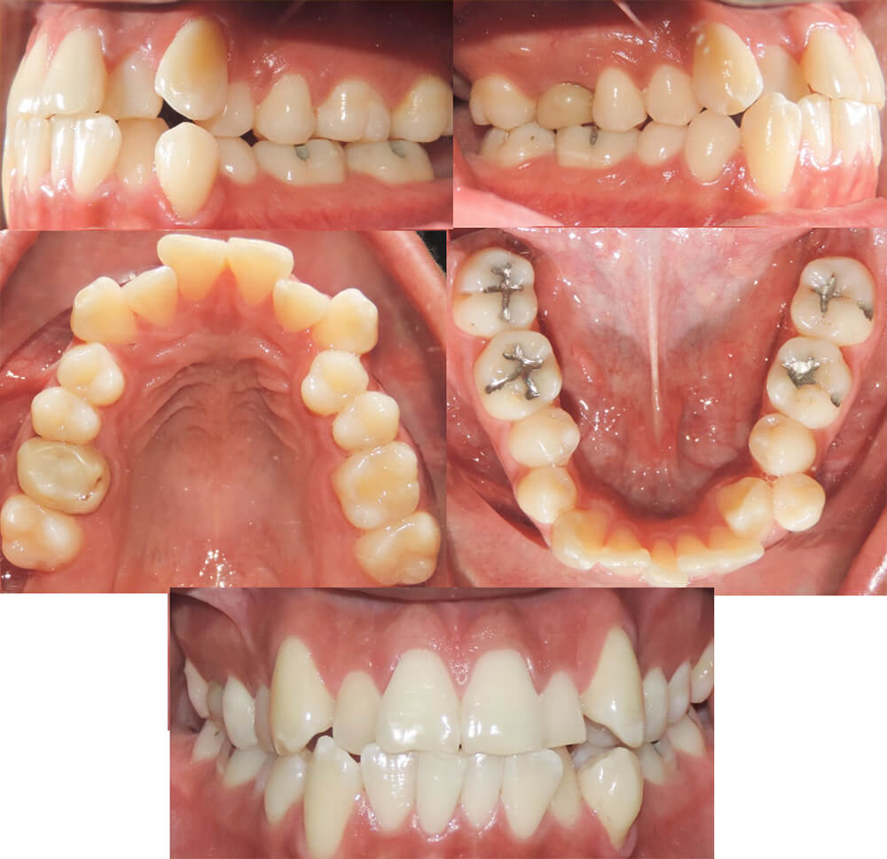 Fig 2. Aspecto intraoral del paciente antes del tratamiento: fotografía frontal laterales y arcada superior e inferior.