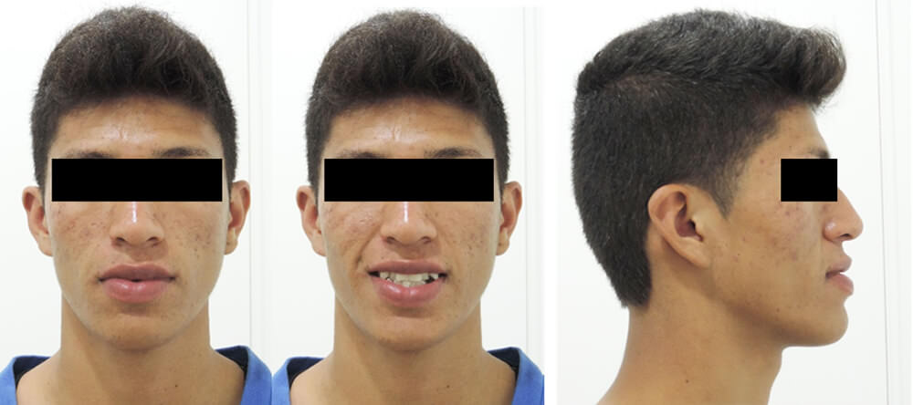 Fig 3. Aspecto facial del paciente antes del tratamiento: de frente en oclusión, sonriendo, de perfil en oclusión.
