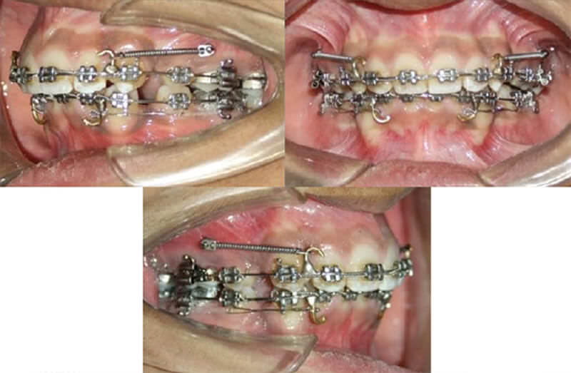 Fig. 1: En-masse retraction using micro-implants and Niti closed coil springs