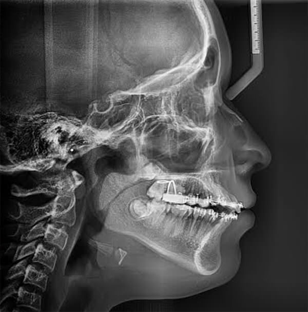 Fig 15. Radiografía lateral de cráneo de progreso
