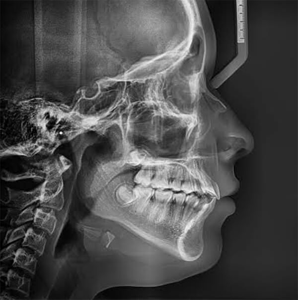 Fig 21. Radiografía lateral de cráneo final