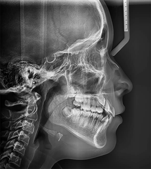 Fig 5. Radiografía lateral de cráneo
