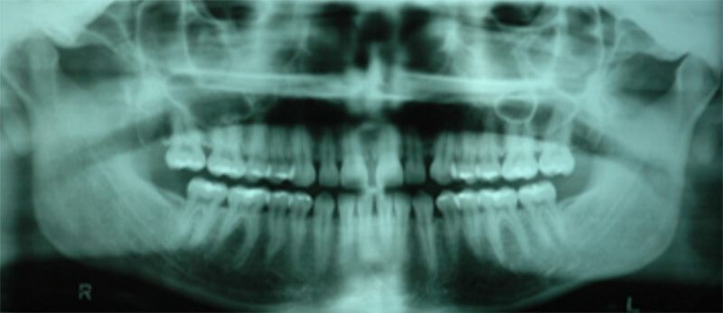 Figura 3. Radiografía lateral de cráneo