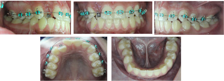Figura 4. Colocación de brackets  en dientes  del maxilar