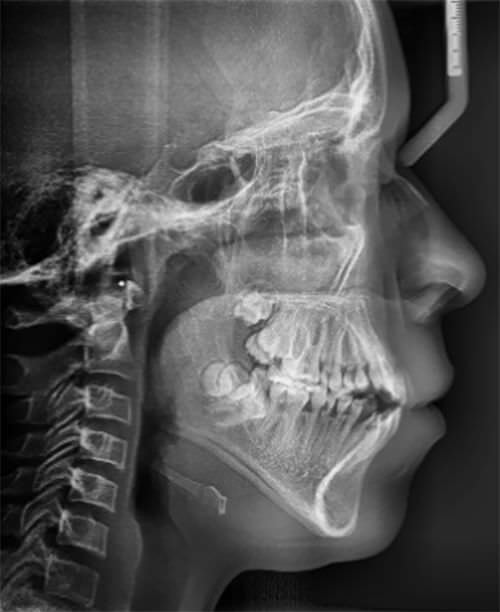 Fig. 1 radiografía lateral de cráneo