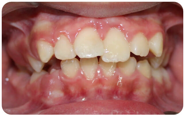 Fotografía 4. Apariencia de los dientes a las 8 semanas de seguimiento, es posible observar la recuperación completa de las lesiones en tejidos blandos, así como una reducción generalizada de la inflamación producida por placa.