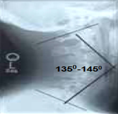 Imagen 1. Radiografía lateral derecha de columna cervical donde se muestra el ángulo para determinar la lordosis cervical