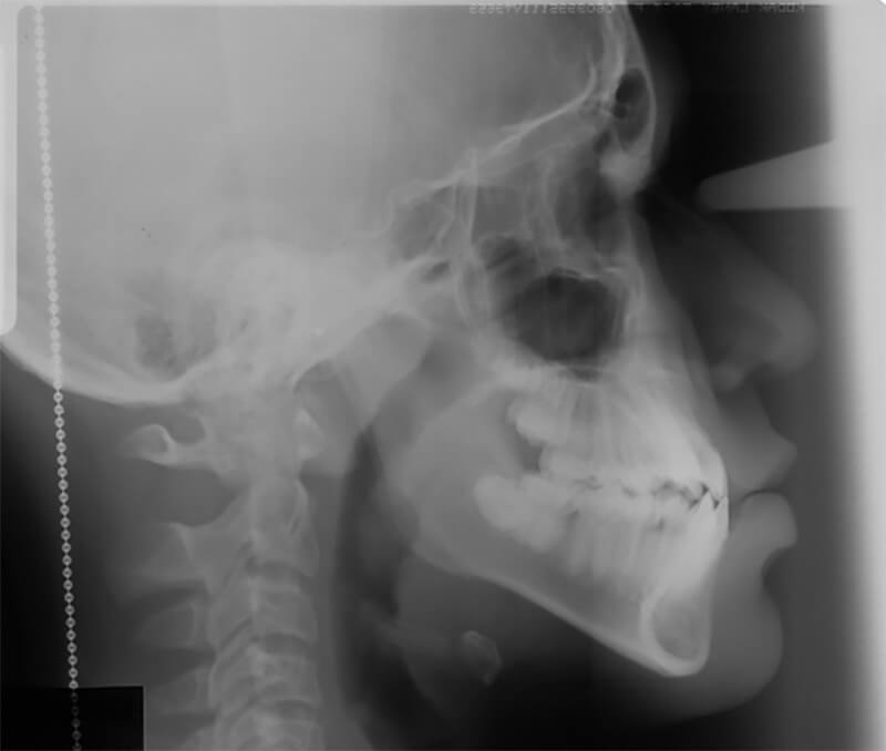 Figura 4. Radiografía lateral de cráneo donde se realizaron los diferentes análisis