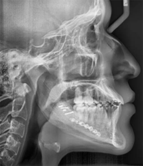 Fig. 11 lateral de cráneo
