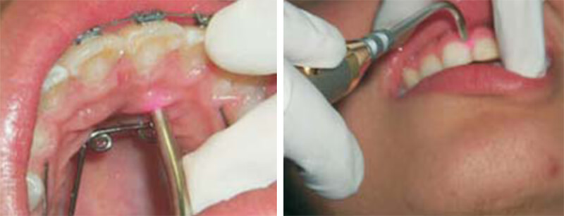 Técnica de irradiación: puntual local: directamente en la papila mesial y distal del diente sobre el cual se ejerce la fuerza y en la mucosa a nivel del ápice radicular.