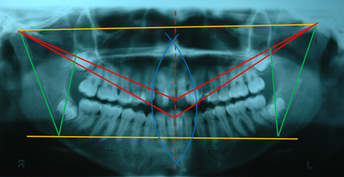 Figura 3. Radiografía ortopantolografia