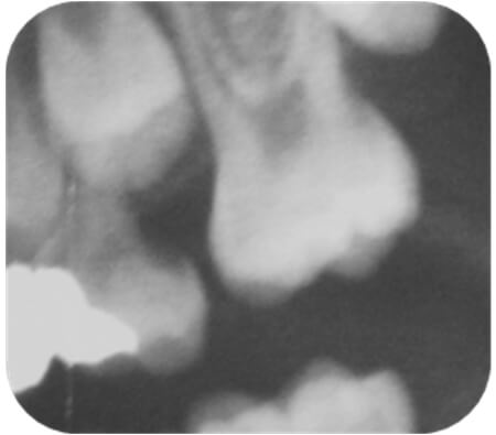 Imagen 2: Radiografía periapical de la zona entre dientes 65 y 26