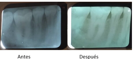 Figura #4. Zona de premolares y molares antes y después del tratamiento. Aunque los cambios radiográficos son discretos, se puede observar reorganización del trabeculado óseo, aumento de la densidad del hueso interradicular y unión de corticales óseas en zona de premolares y molares.