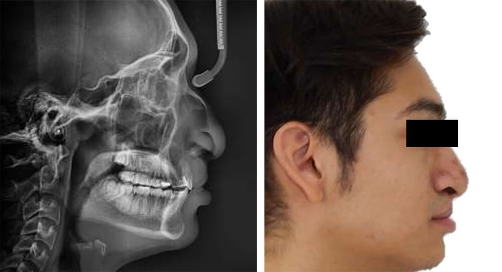 Fig. 10 Rx Lateral de cráneo y perfil
