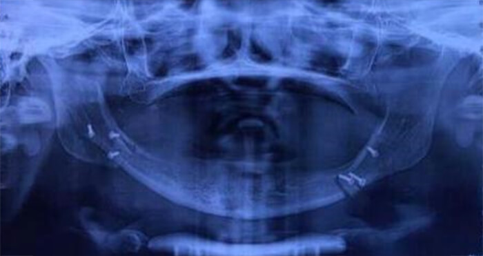 Figura 2: Radiografía panorámica, posterior al tratamiento inicial con tornillos bicorticales.