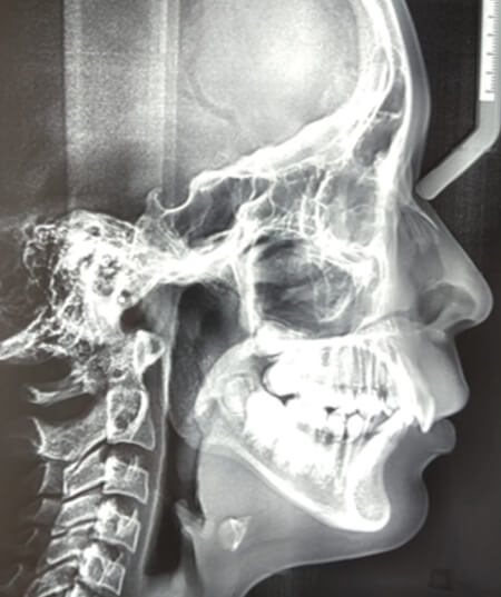 Figura 2. Radiografía panorámica y lateral de inicio