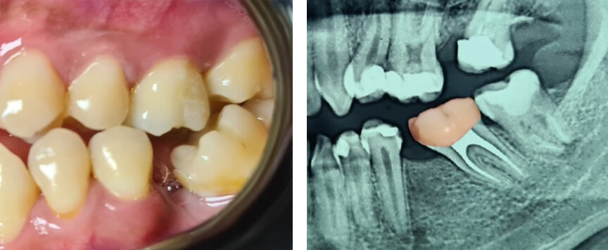 Fig.2   A. Fotografía  intraoral presencia de bacteriana y bolsas  periodontales por la  inclinación del  segundo molar inferior  permanente. B mesioinclinación  del segundo molar en Radiografía  Panorámica. - Fuente: propia