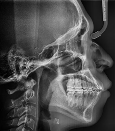 Fig. 12 Radiografía lateral de cráneo final