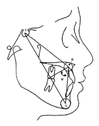 Figura 3: Construcción Ángulo W (Wasundhara, B et al., 2011)