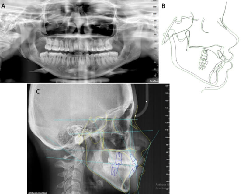 Figura 9. Radiografías y trazados finales. A) Ortopantomografía B) Superimposición C) Trazado Cefalométrico.