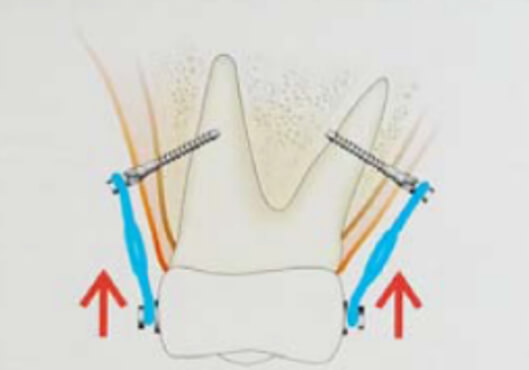 Figura 1. Intrusión molar superior por vestibular y palatino (Tomada de Echarri 2007).