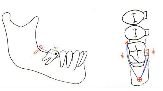 Figura 3. Esquema del tratamiento para verticalización de molar (Tomada de Lorente 2004).