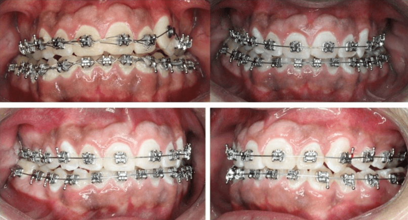 Fig. 4: A)Placa activa con tornillo de expansión B) seguimiento