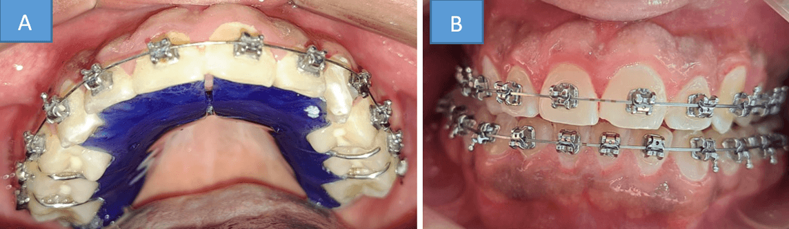 Fig. 5: A) elásticos intermaxilares B) Topes oclusales C) Descruzo lado derecho