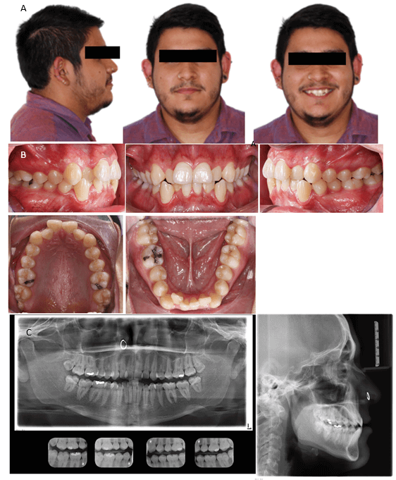 Fig. 1. Fotografías iniciales faciales (A), fotografías intraorales iniciales (B), radiografías panorámica, teleradiografia y BW iniciales (C)