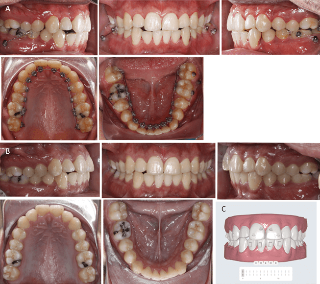 ig. 3, Fotos intraorales mes 11 de tratamiento (A), fotos intraorales luego del retiro de aparatos fijos (B), Set up virtual, vista frontal (C)
