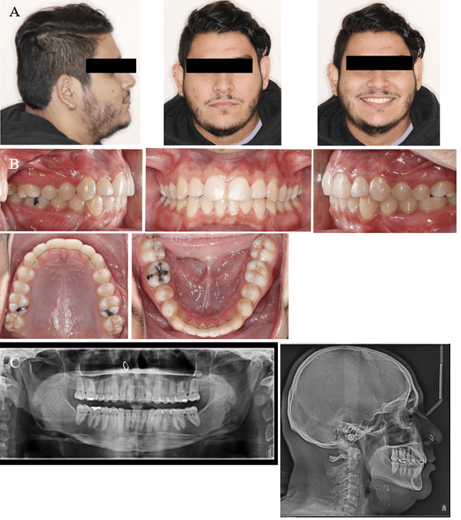 Fig. 4,  Fotos faciales finales (A). Fotos intraorales finales (B). Radiografía panorámica final y telerradiografía lateral final (C)