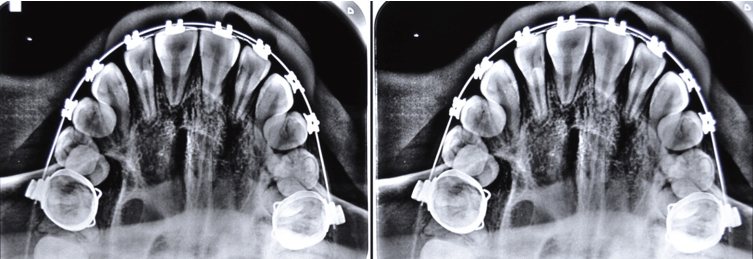 Radiografía Oclusal