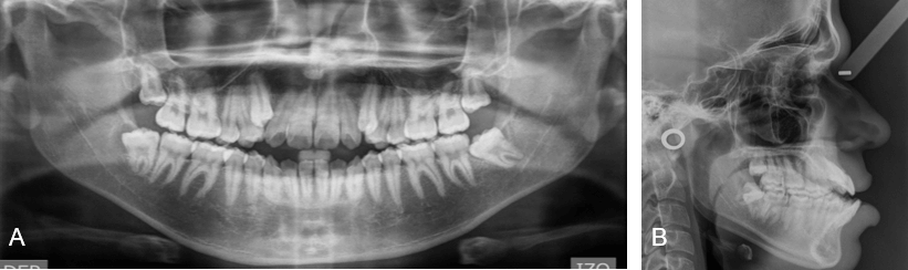 Figura 3. Radiografías Iniciales. A. Panorámica. B. Cefálica Lateral.
