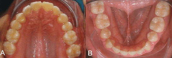 Figura 5. Fotografías Intraorales Finales. A. Arco Superior. B. Arco inferior.