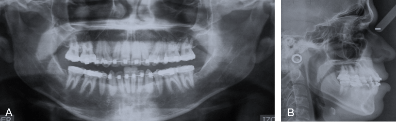Figura 6. Radiografías Finales. A. Panorámica. B. Cefálica Lateral.