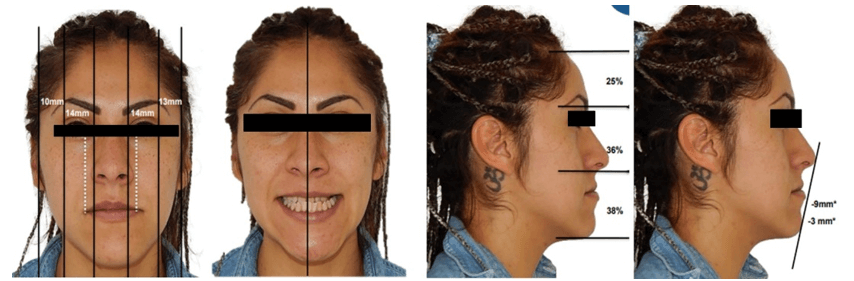 Fig. 1 extraoral de frente reposo y sonrisa, perfil