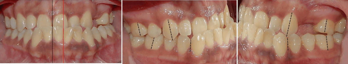 Fig. 2 Mordida cruzada anterior, derecha, izquierda