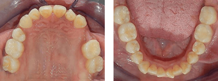 Fig.3 vista oclusal superior inferior