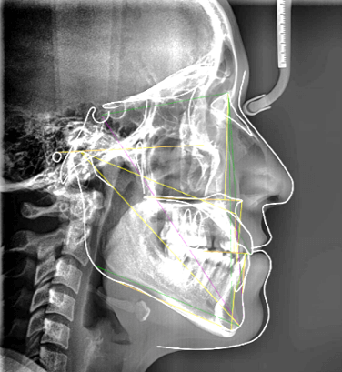 Fig.4 Lateral de cráneo con trazos