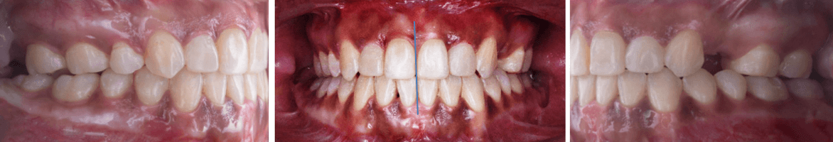 Fig. 7 intraorales finales y lateral derecha de frente izquierda.