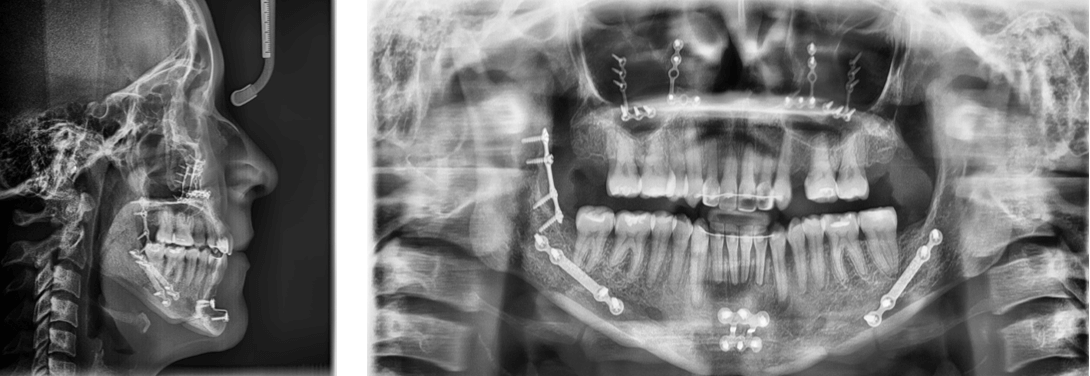 Fig. 8 Imágenes radiográficas finales. Radiografía Lateral de cráneo y panorámica