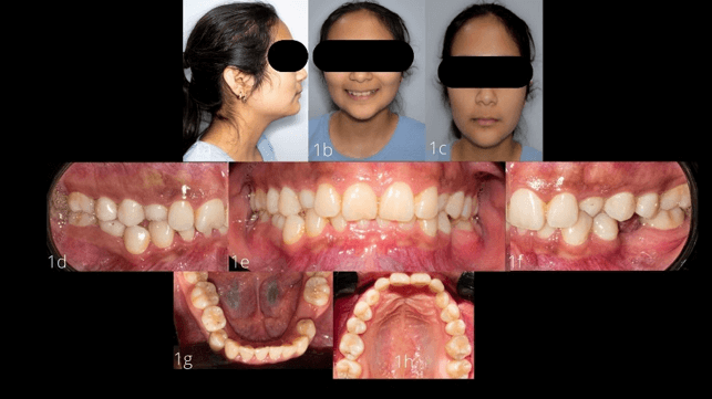 Figura n° 1. Registros fotográficos iniciales. Fotografía de perfil, frontal y frontal de sonrisa, más secuencia intraoral. Fuente: Los autores.