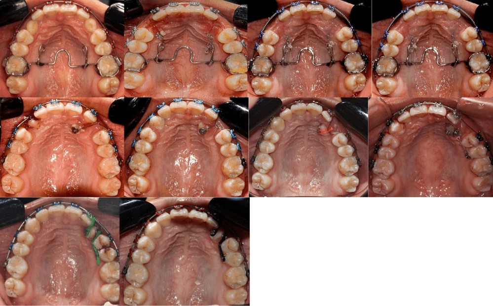 Figura n°12. Evolución del tratamiento, desde su inicio hasta que los caninos maxilares llegar a su posición en arcada en apenas 12 meses de tratamiento. Fuente: Los autores.