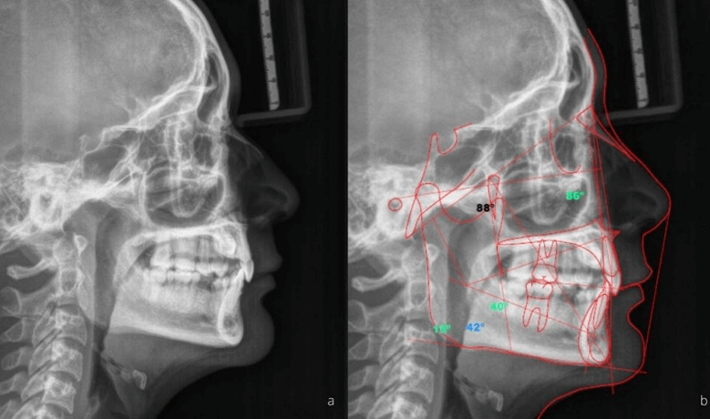Figura n°5. Trazado cefalométrico digital. Fuente: Los autores.