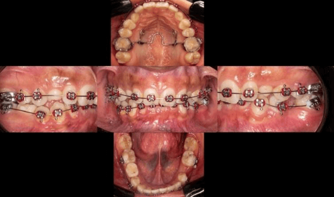 Figura n°6. Inicio de tratamiento. Instalación de Ortodoncia + aparatología fija para tracción de caninos. Fuente: Los autores.