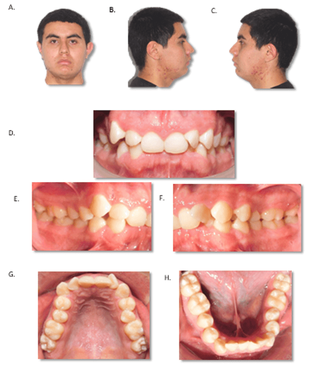 Figura 1. Fotografías clínicas.  Fotografías extra orales: A) frontal, B) lateral derecha, C) lateral izquierda; fotografías intraorales: D) frontal, E) lateral derecha, F) lateral izquierda G) oclusal superior, H) oclusal inferior.