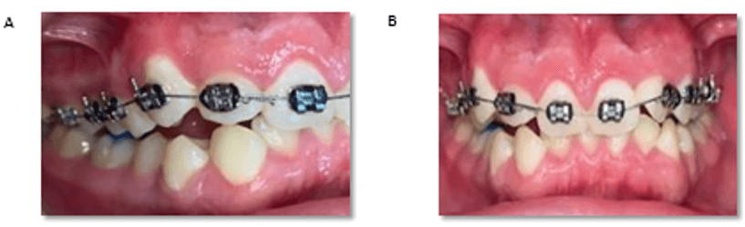 Figura 3. Colocación de topes en molares inferiores para levantar la mordida.  A) colocación de los topes, vista lateral, B) colocación de los topes, vista frontal. 
